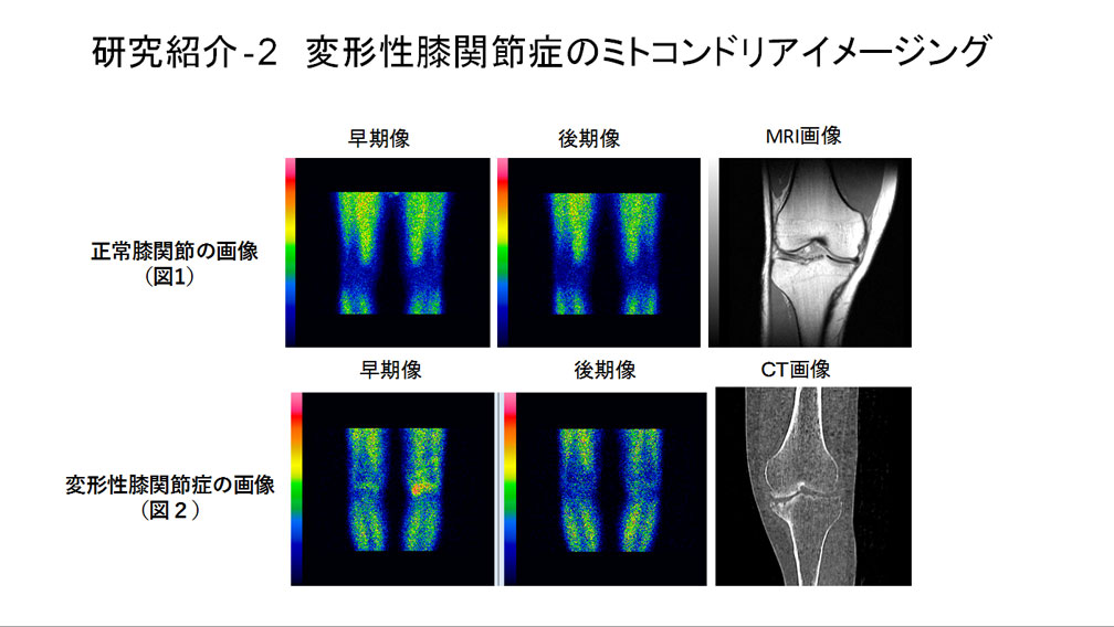 変形性膝関節症のミトコンドリアイメージング